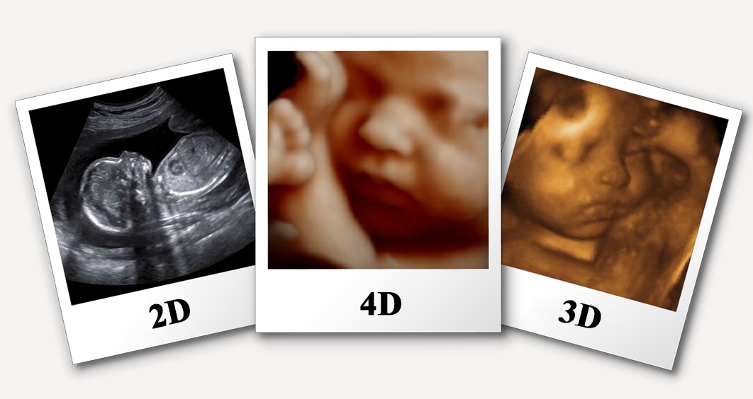 3D 4D ultrasound scan